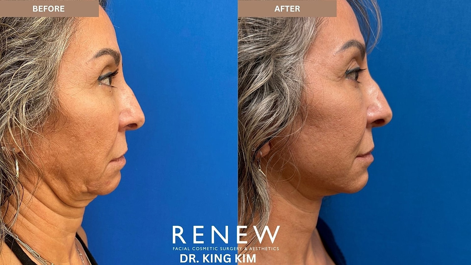Abbreviated Facelift Before & After
