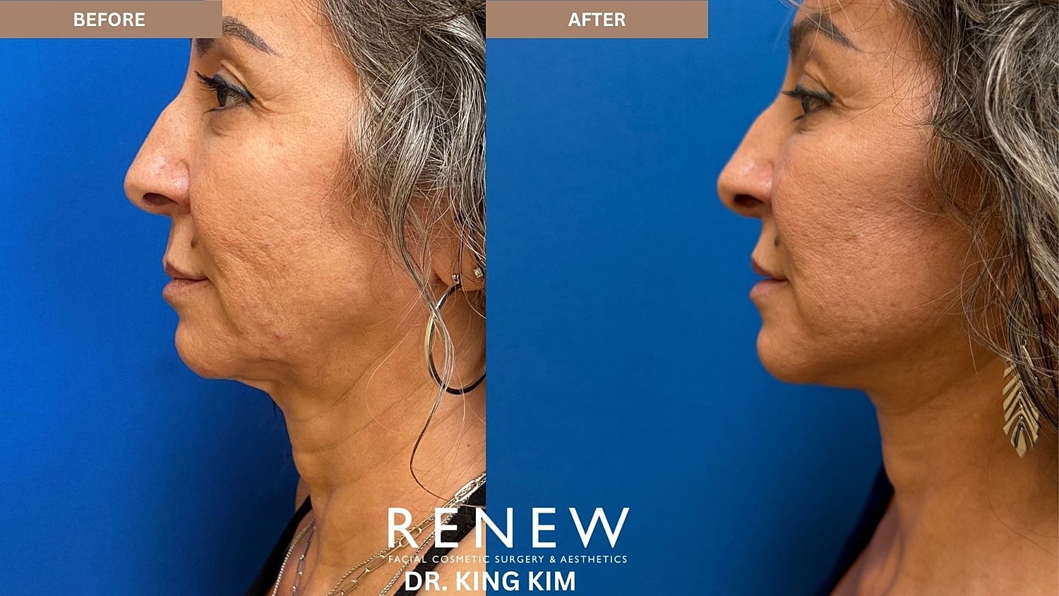 Abbreviated Facelift Before & After