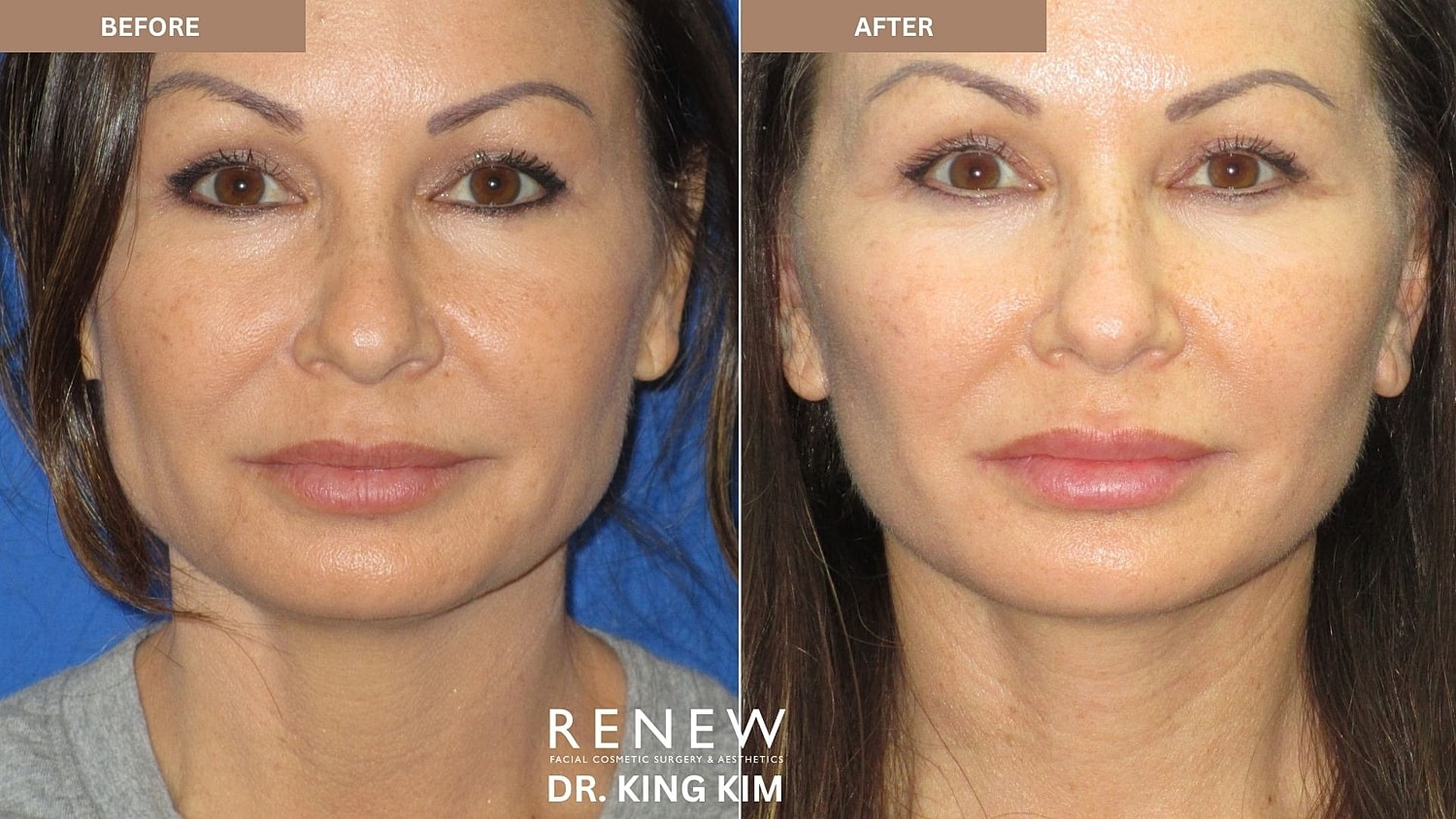 Abbreviated Facelift Before & After