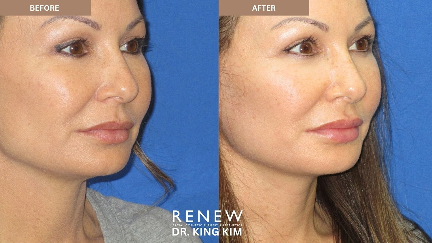 Abbreviated Facelift Before & After