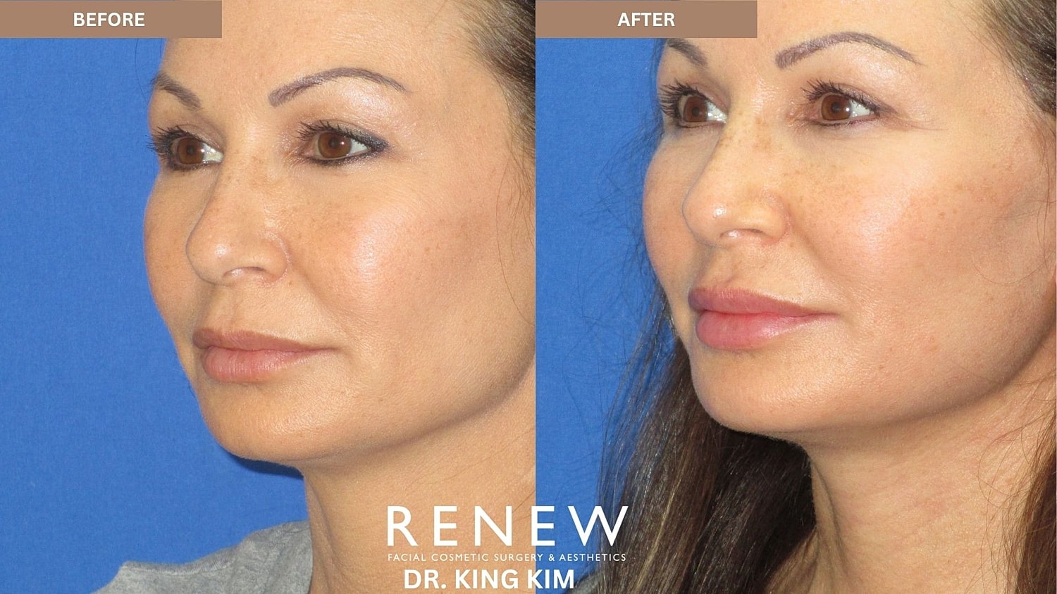 Abbreviated Facelift Before & After