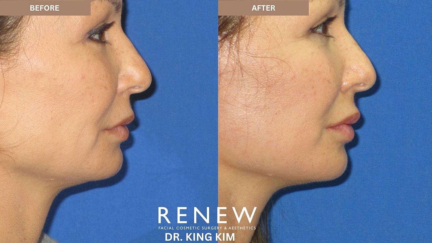 Abbreviated Facelift Before & After