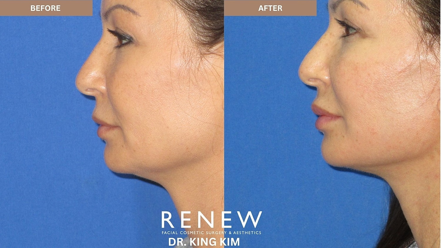 Abbreviated Facelift Before & After