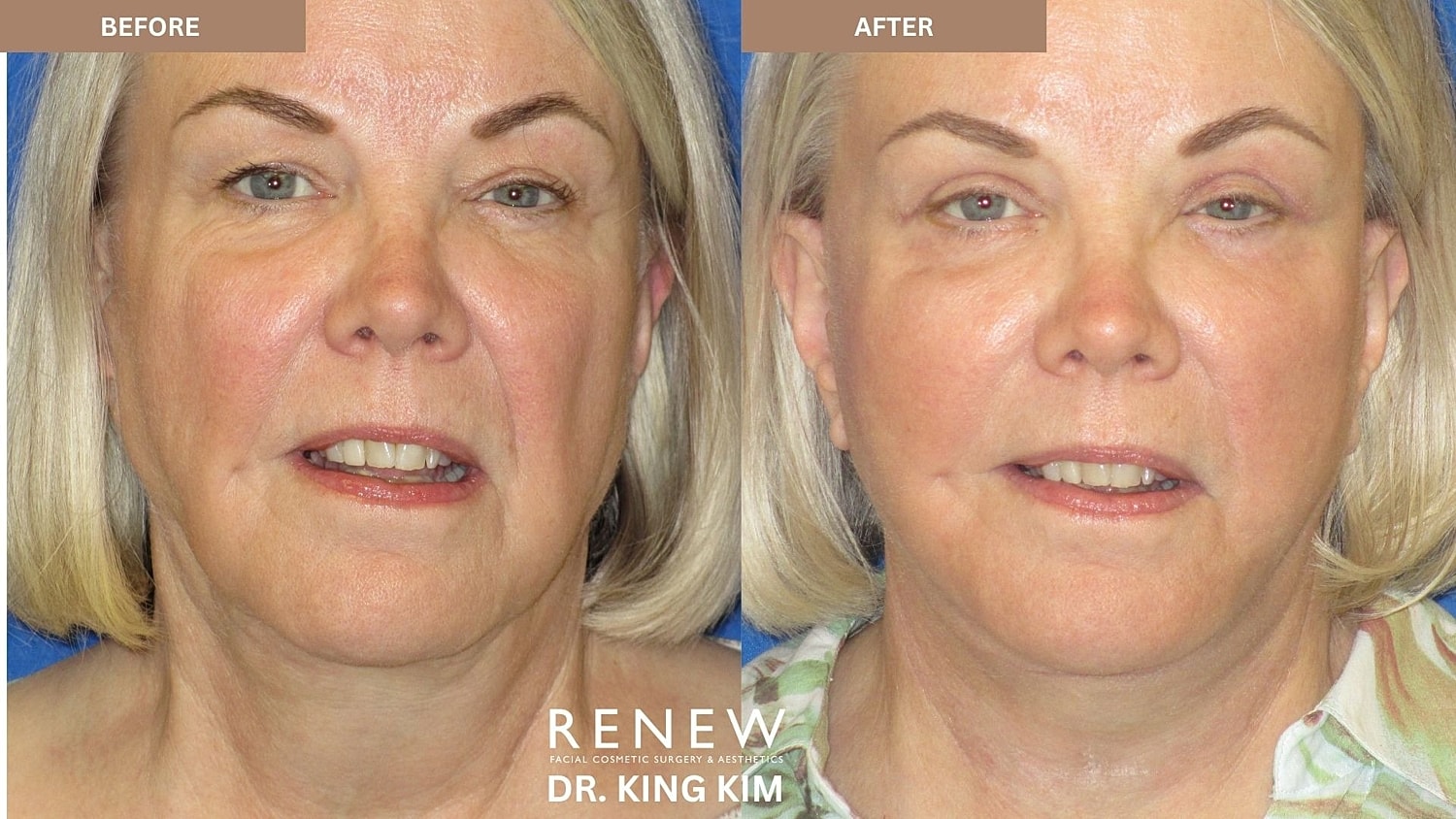 Abbreviated Facelift Before & After