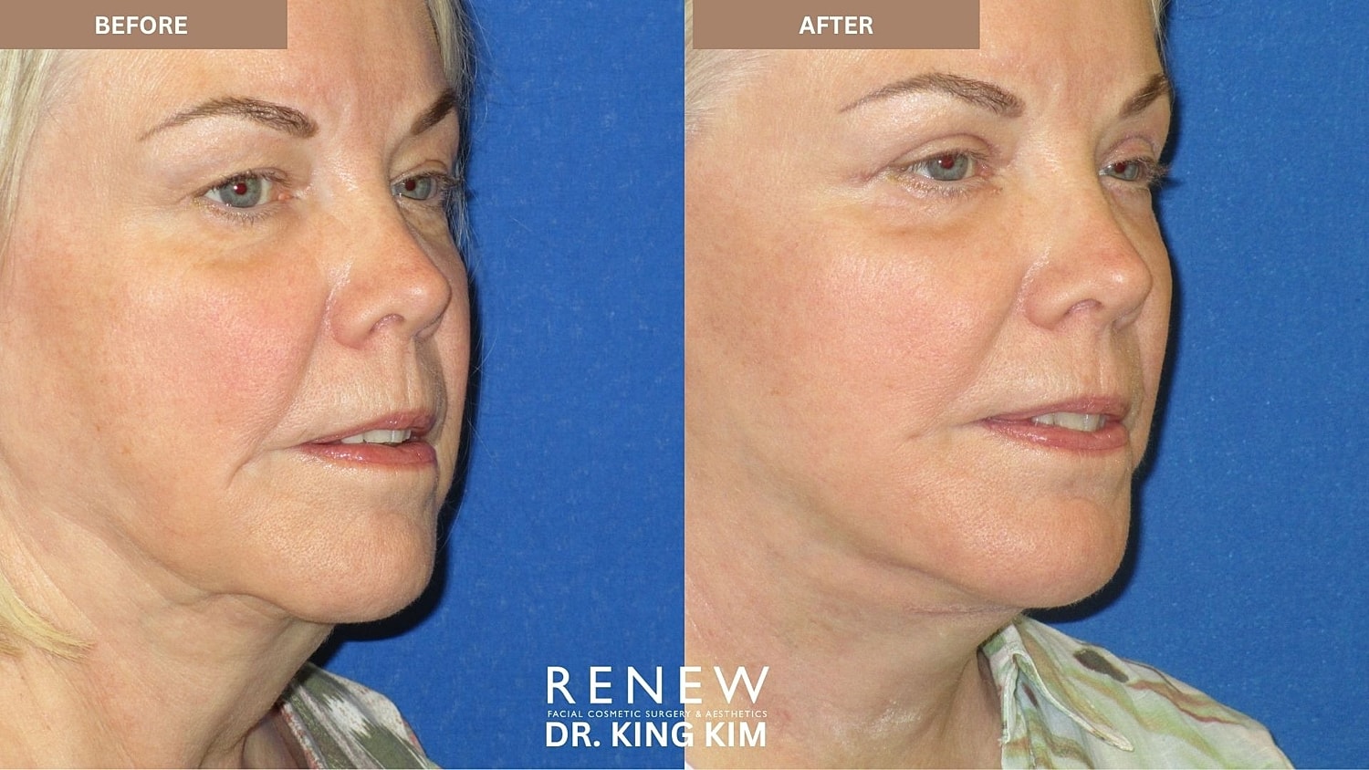 Abbreviated Facelift Before & After