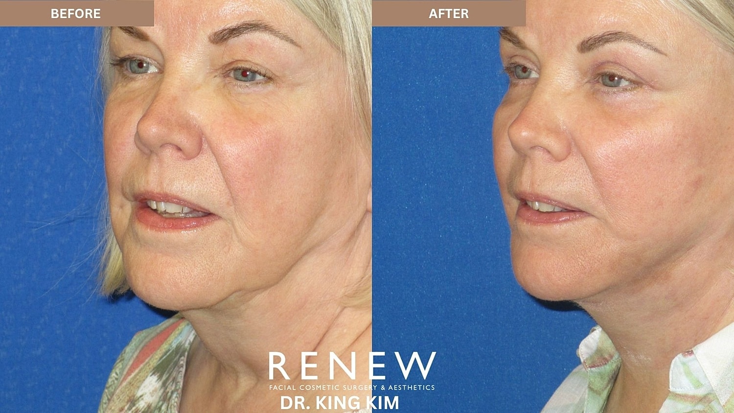 Abbreviated Facelift Before & After