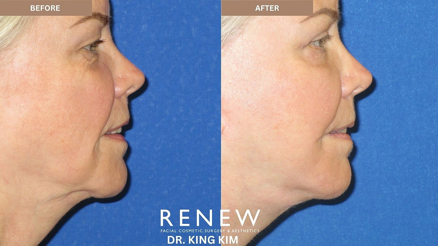 Abbreviated Facelift Before & After