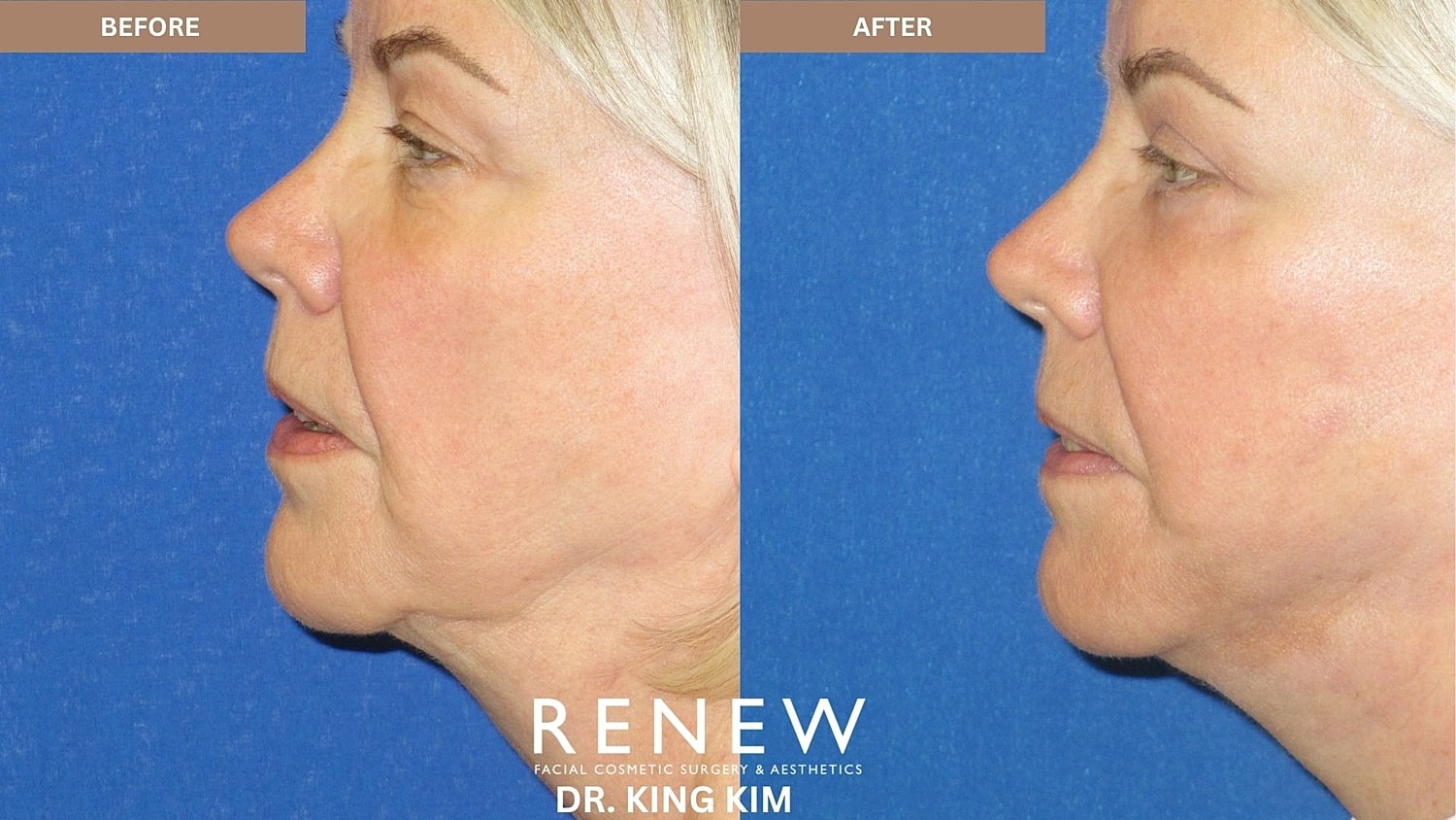 Abbreviated Facelift Before & After