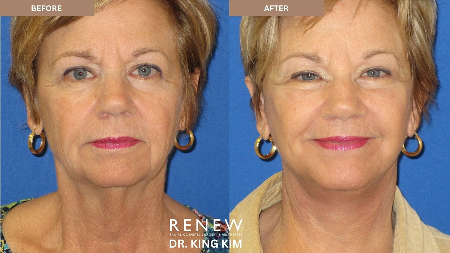 Abbreviated Facelift Before & After