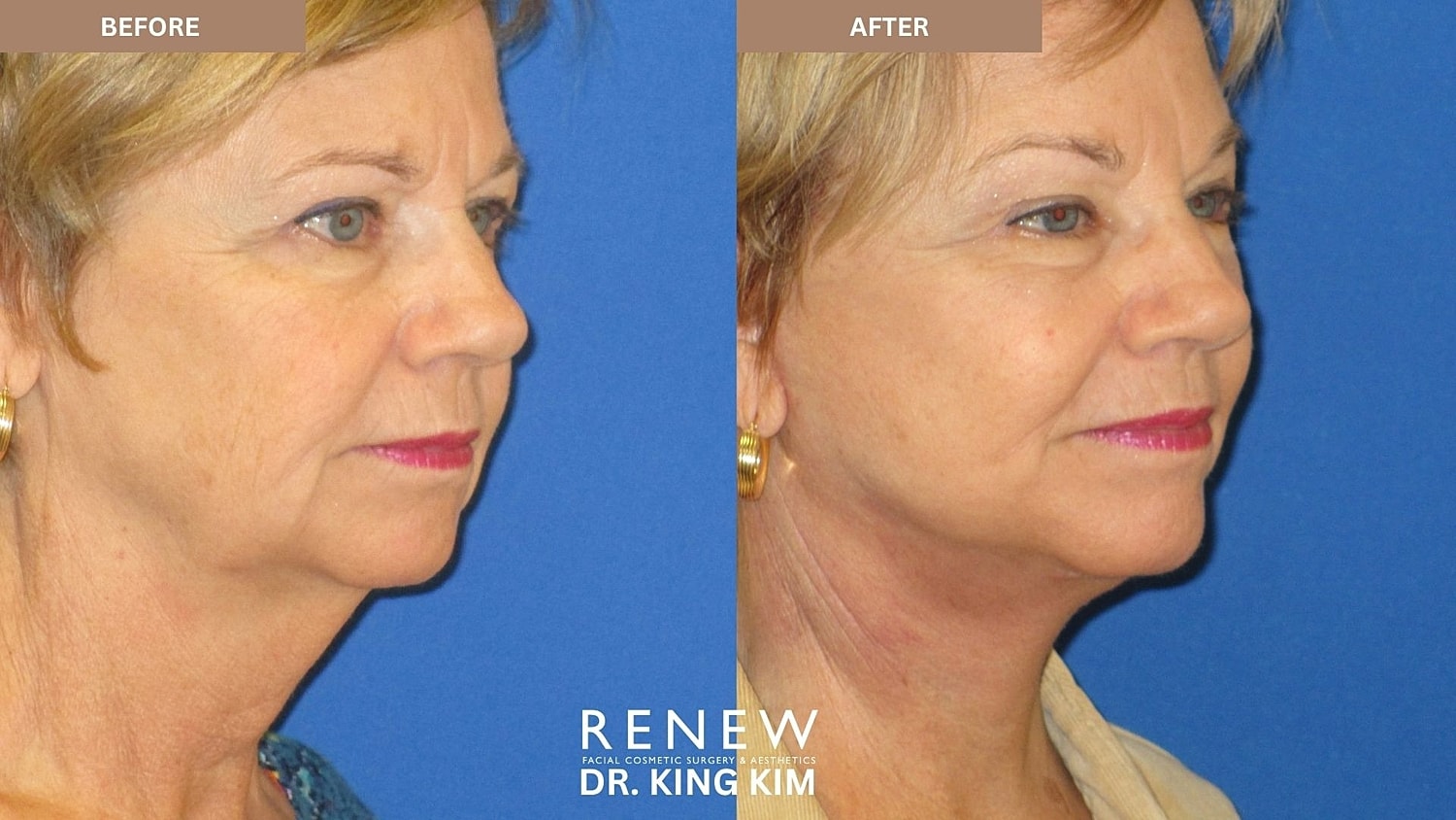 Abbreviated Facelift Before & After