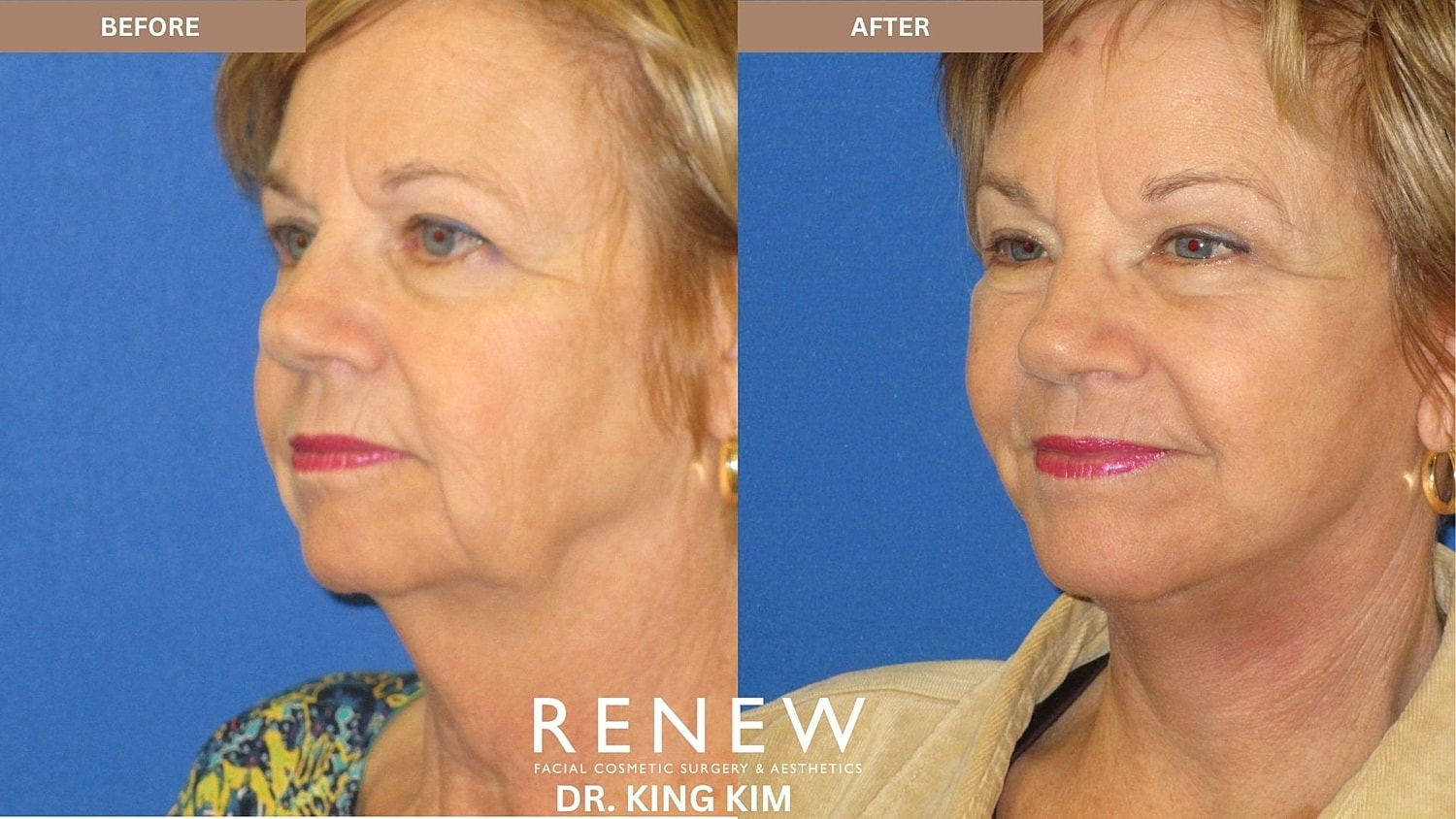 Abbreviated Facelift Before & After