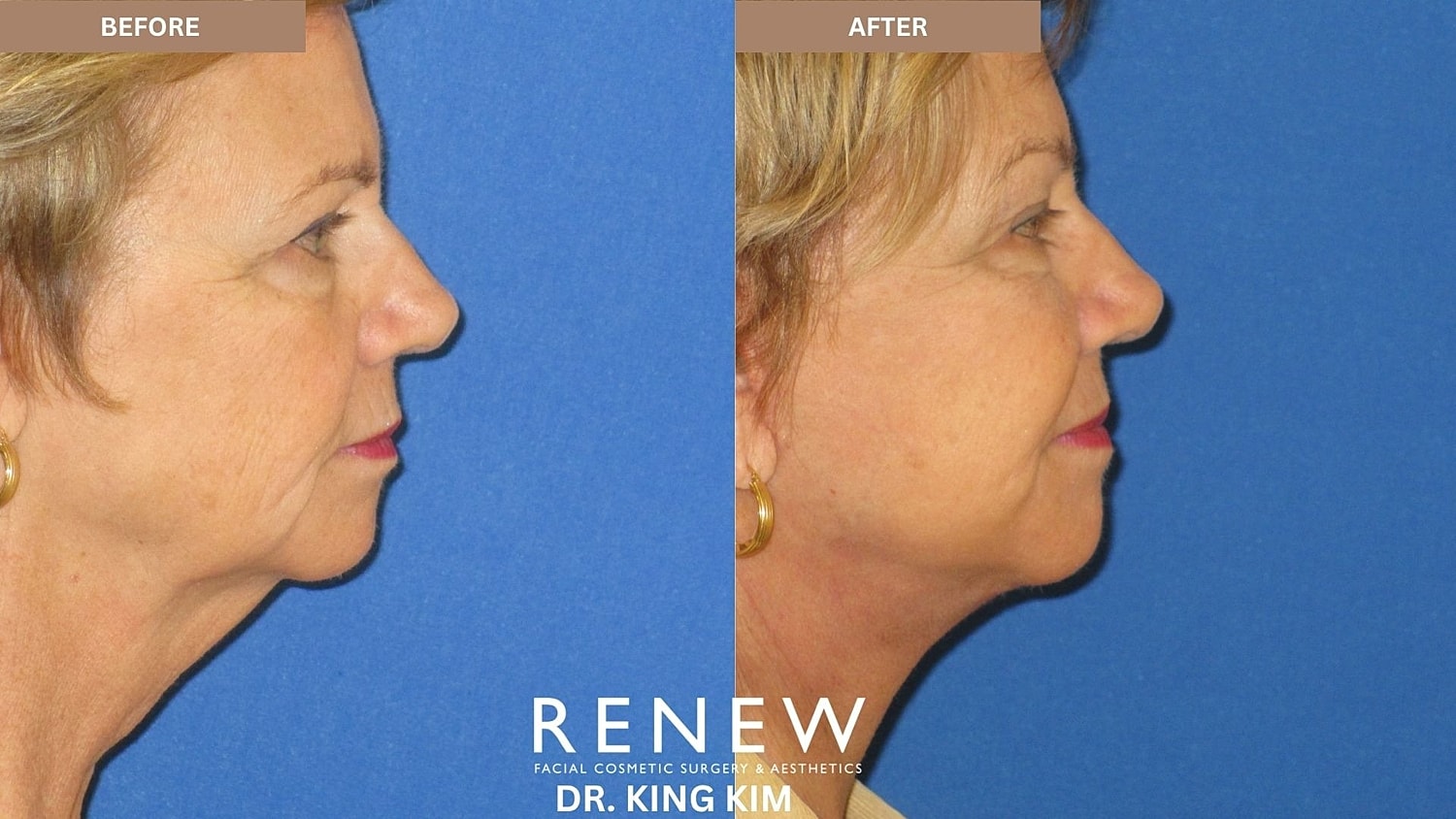 Abbreviated Facelift Before & After