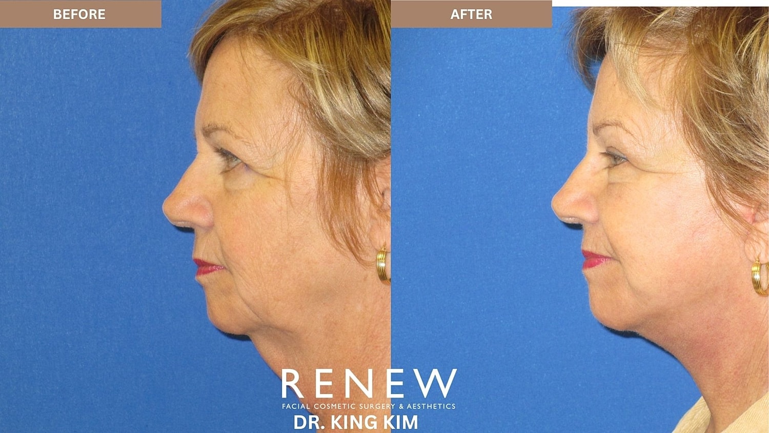 Abbreviated Facelift Before & After