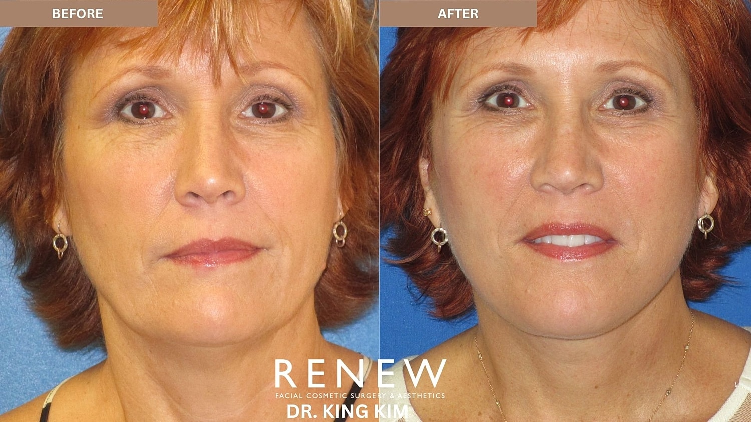 Abbreviated Facelift Before & After