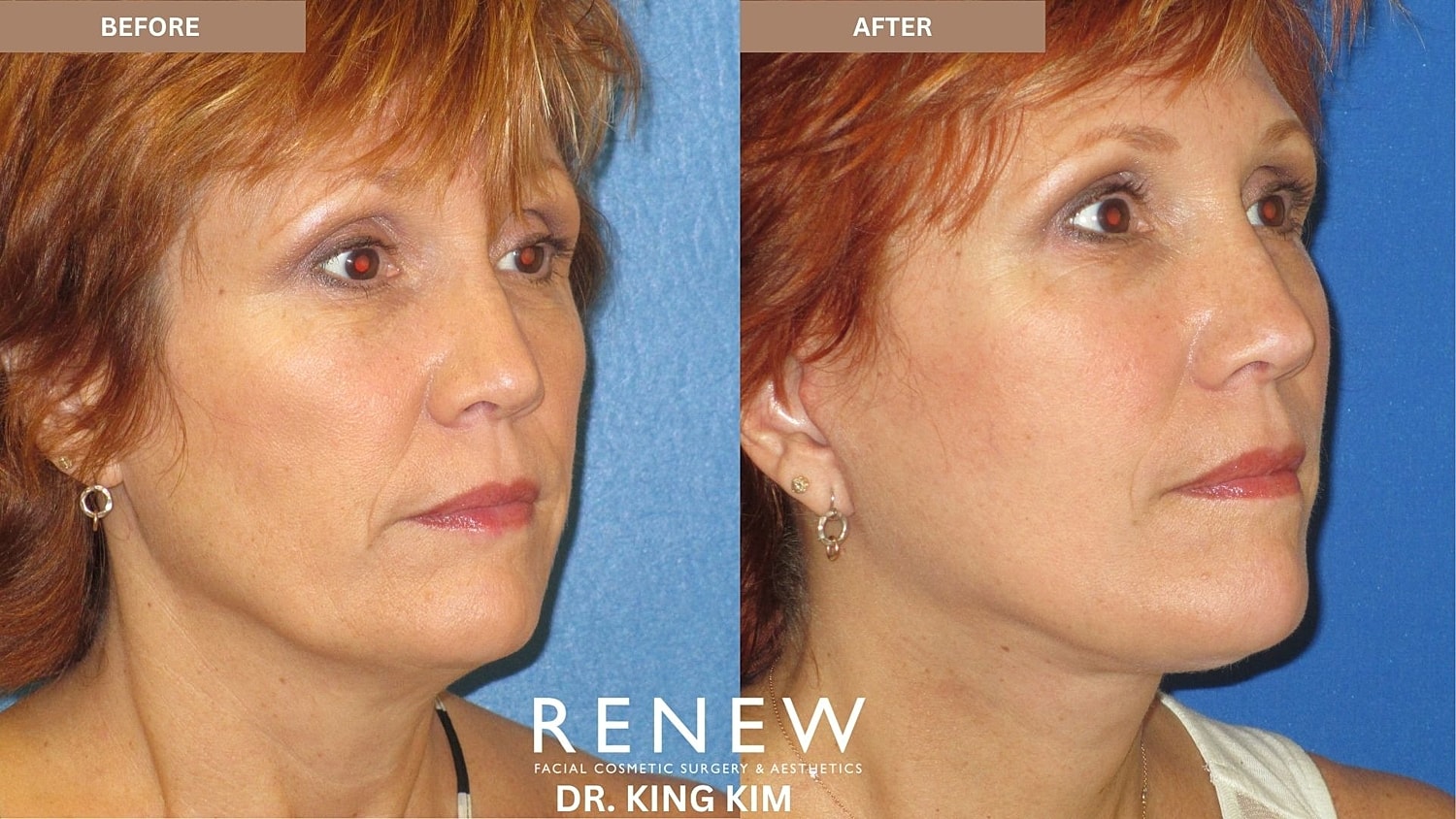 Abbreviated Facelift Before & After