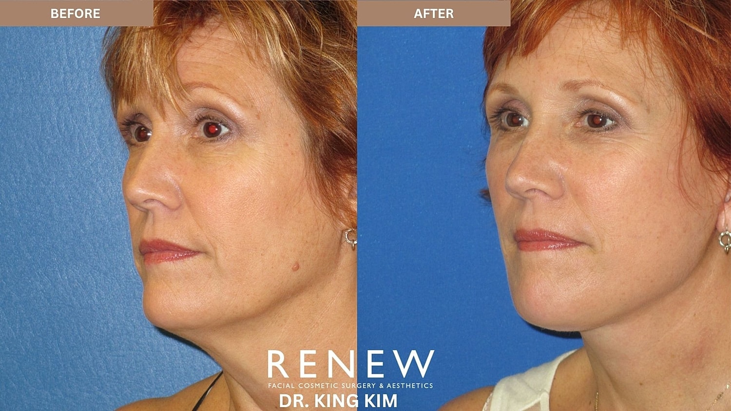 Abbreviated Facelift Before & After