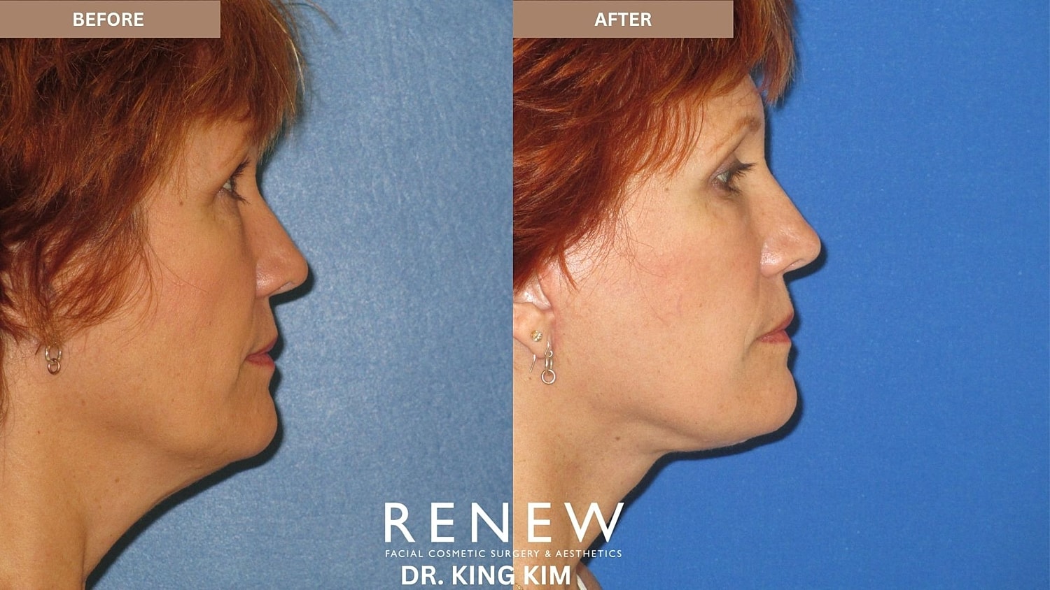 Abbreviated Facelift Before & After