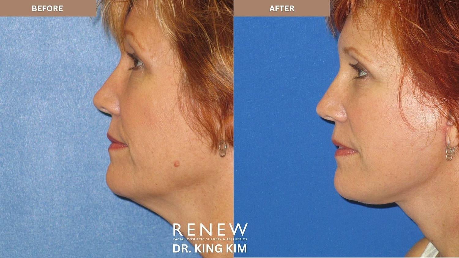 Abbreviated Facelift Before & After