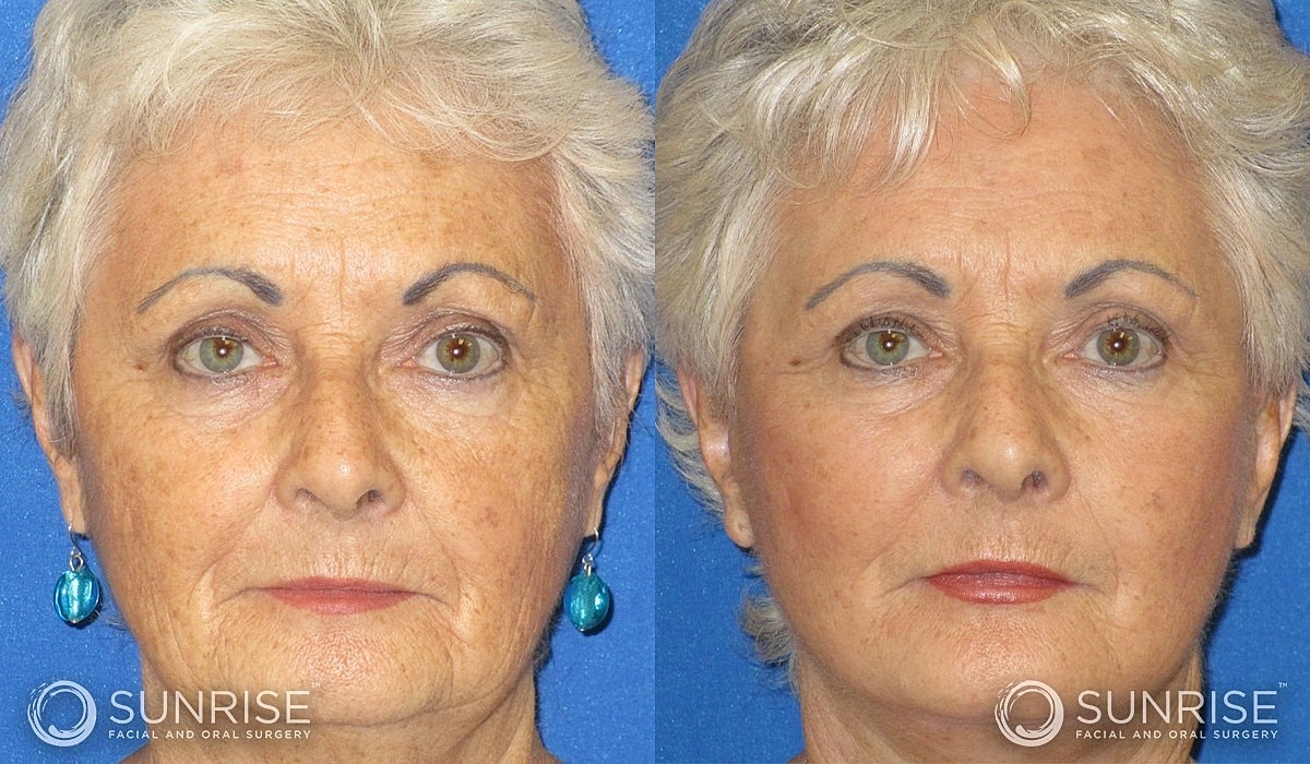 Abbreviated Facelift Before & After