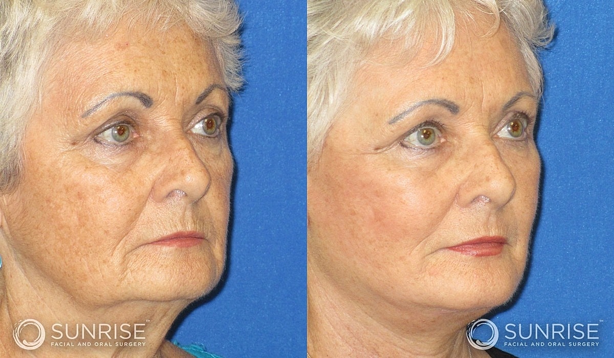 Abbreviated Facelift Before & After