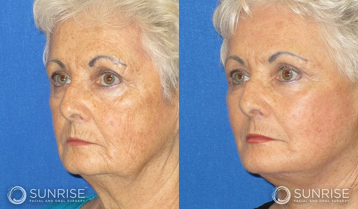 Abbreviated Facelift Before & After
