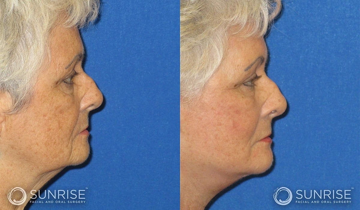 Abbreviated Facelift Before & After
