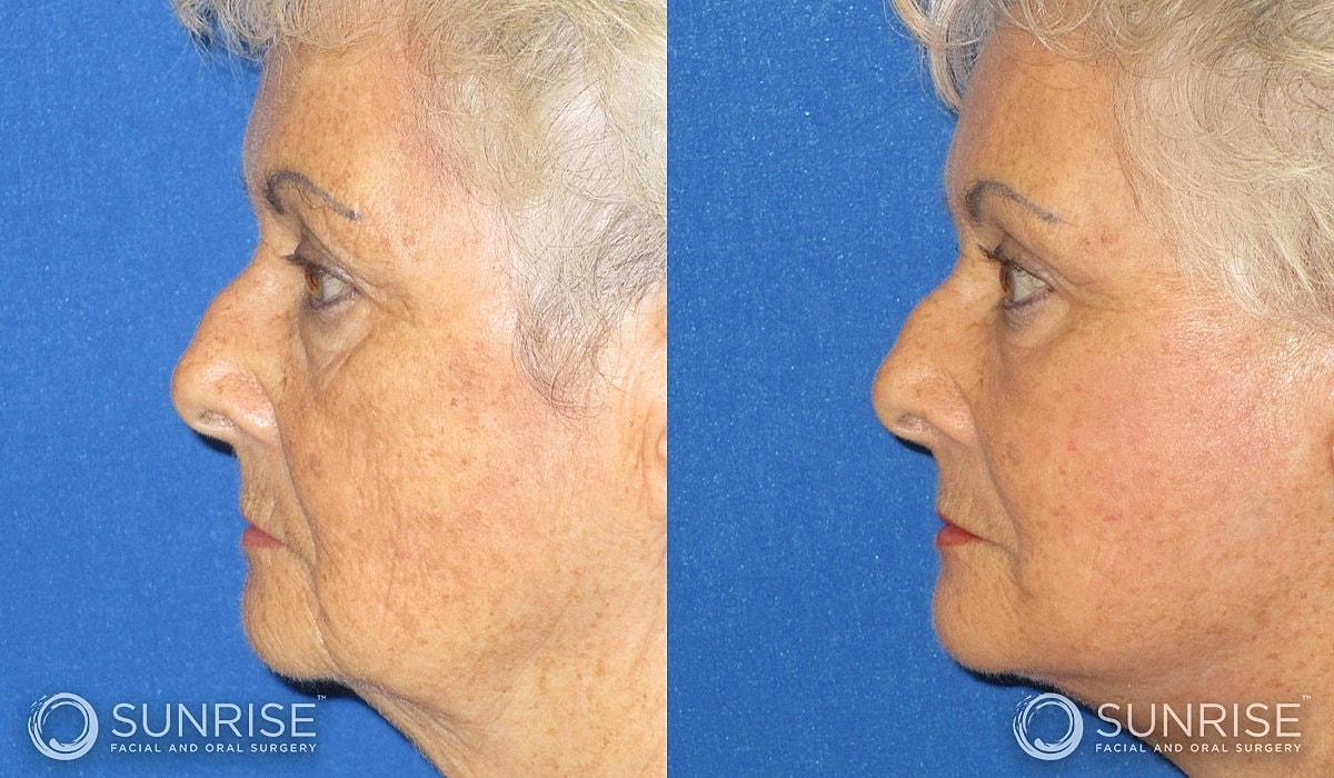Abbreviated Facelift Before & After