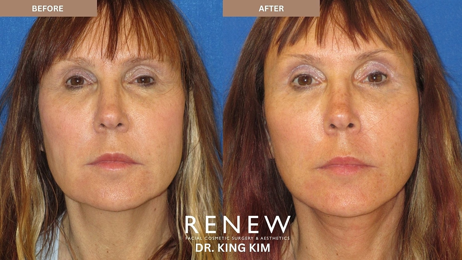 Abbreviated Facelift Before & After