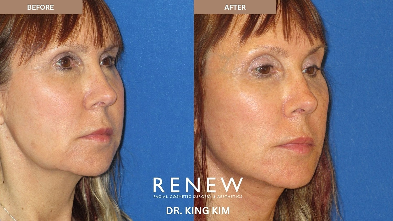 Abbreviated Facelift Before & After