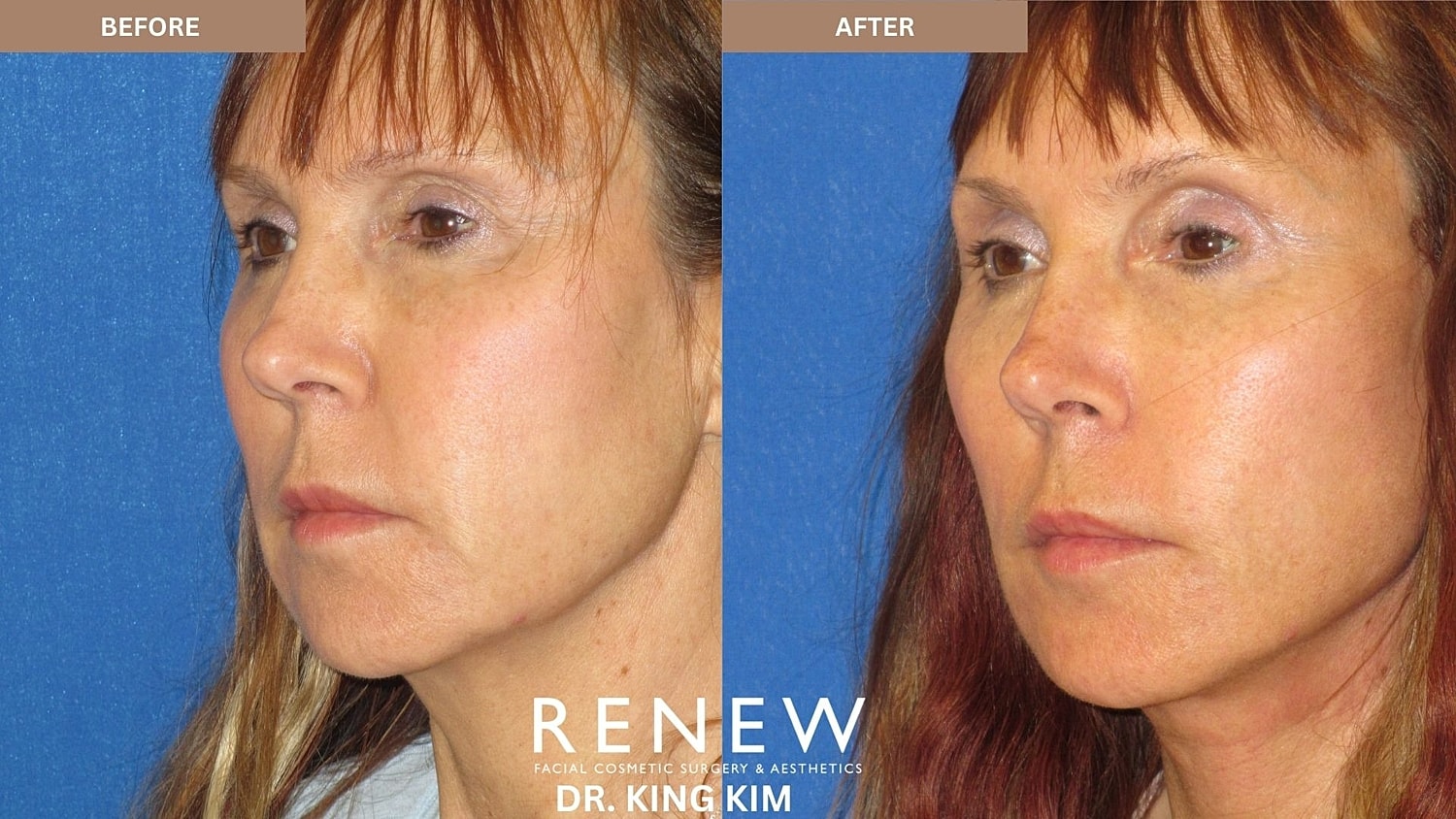 Abbreviated Facelift Before & After