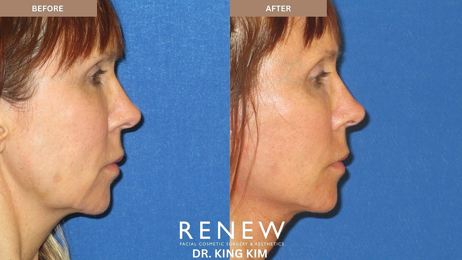 Abbreviated Facelift Before & After