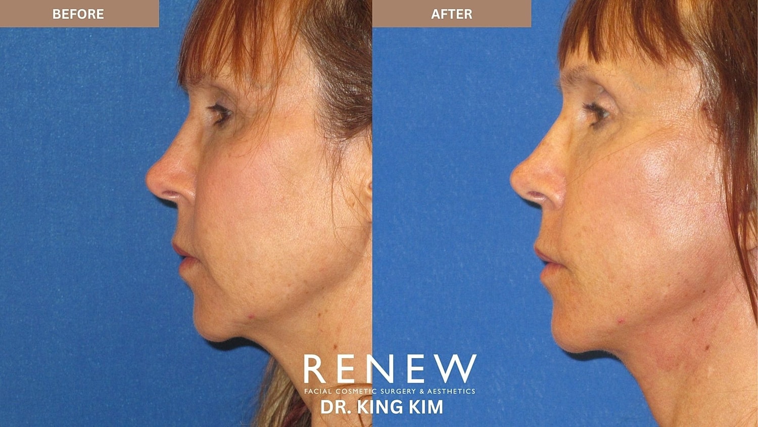Abbreviated Facelift Before & After