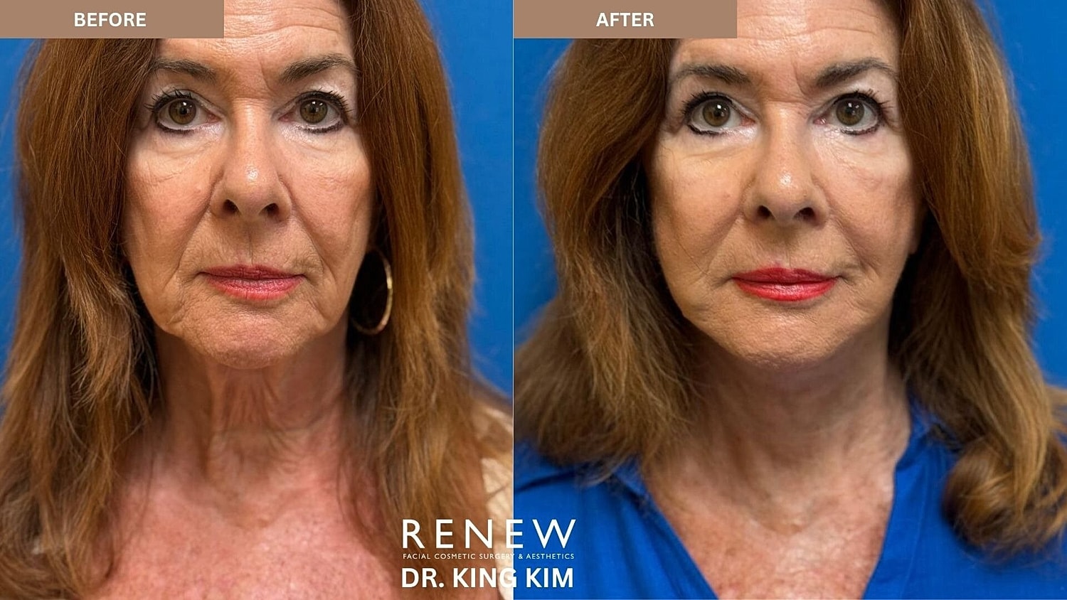 Deep Plane Facelift Before & After