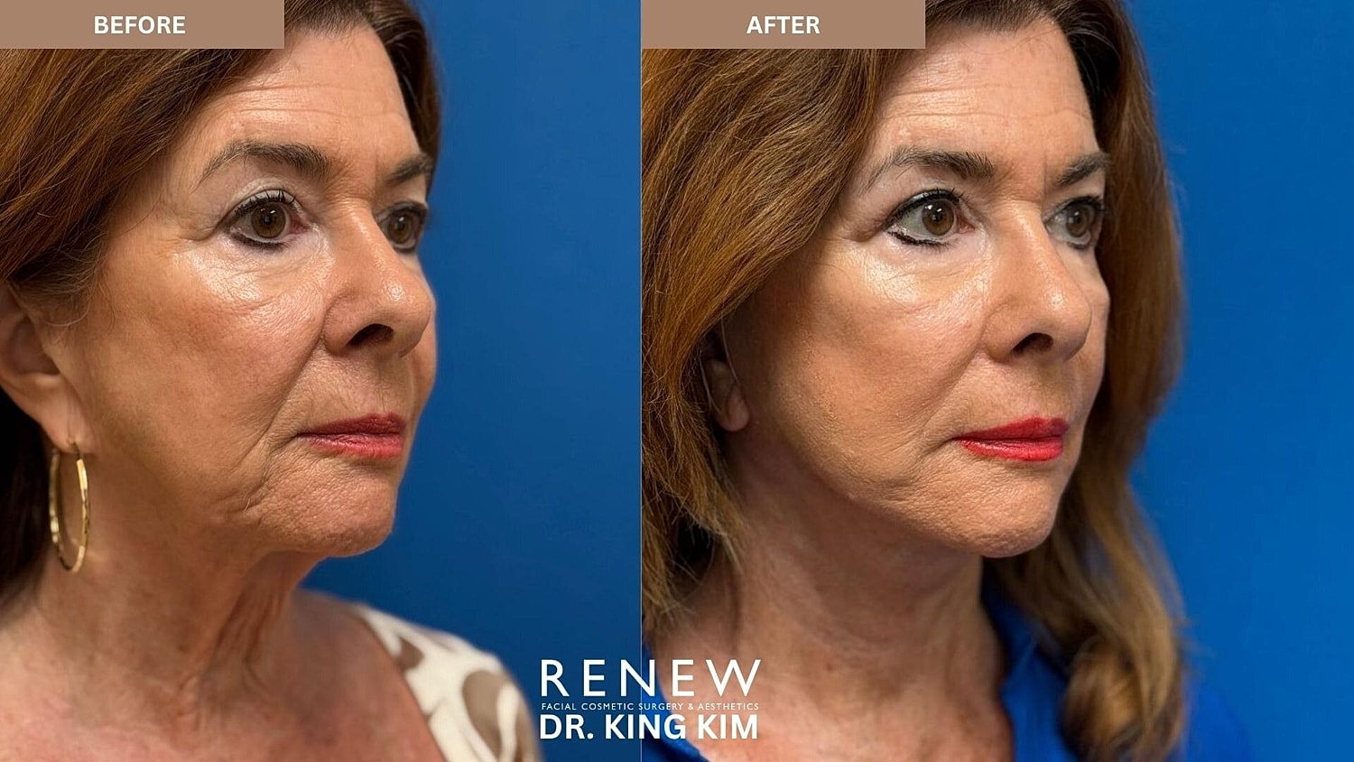 Deep Plane Facelift Before & After