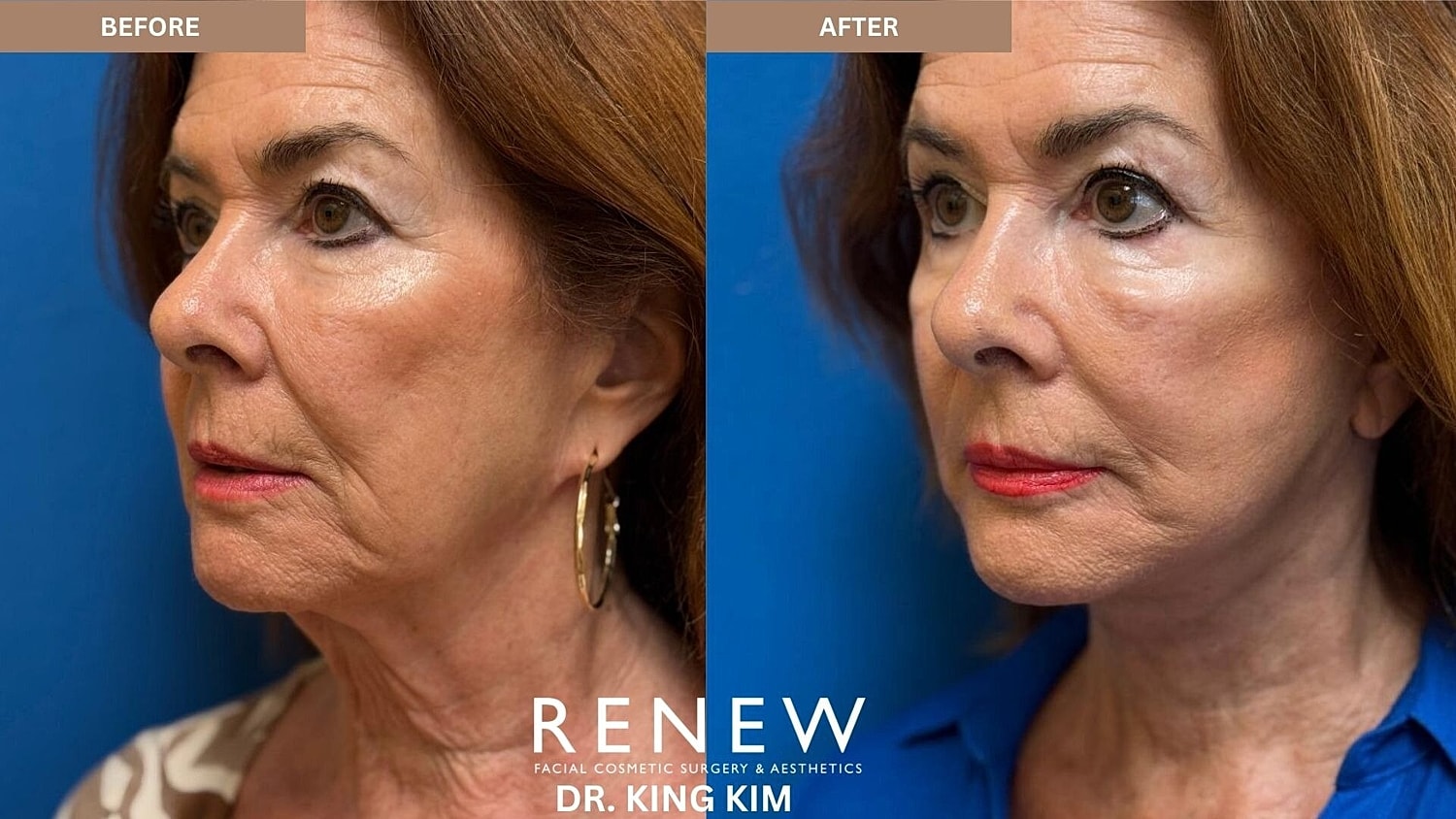 Deep Plane Facelift Before & After
