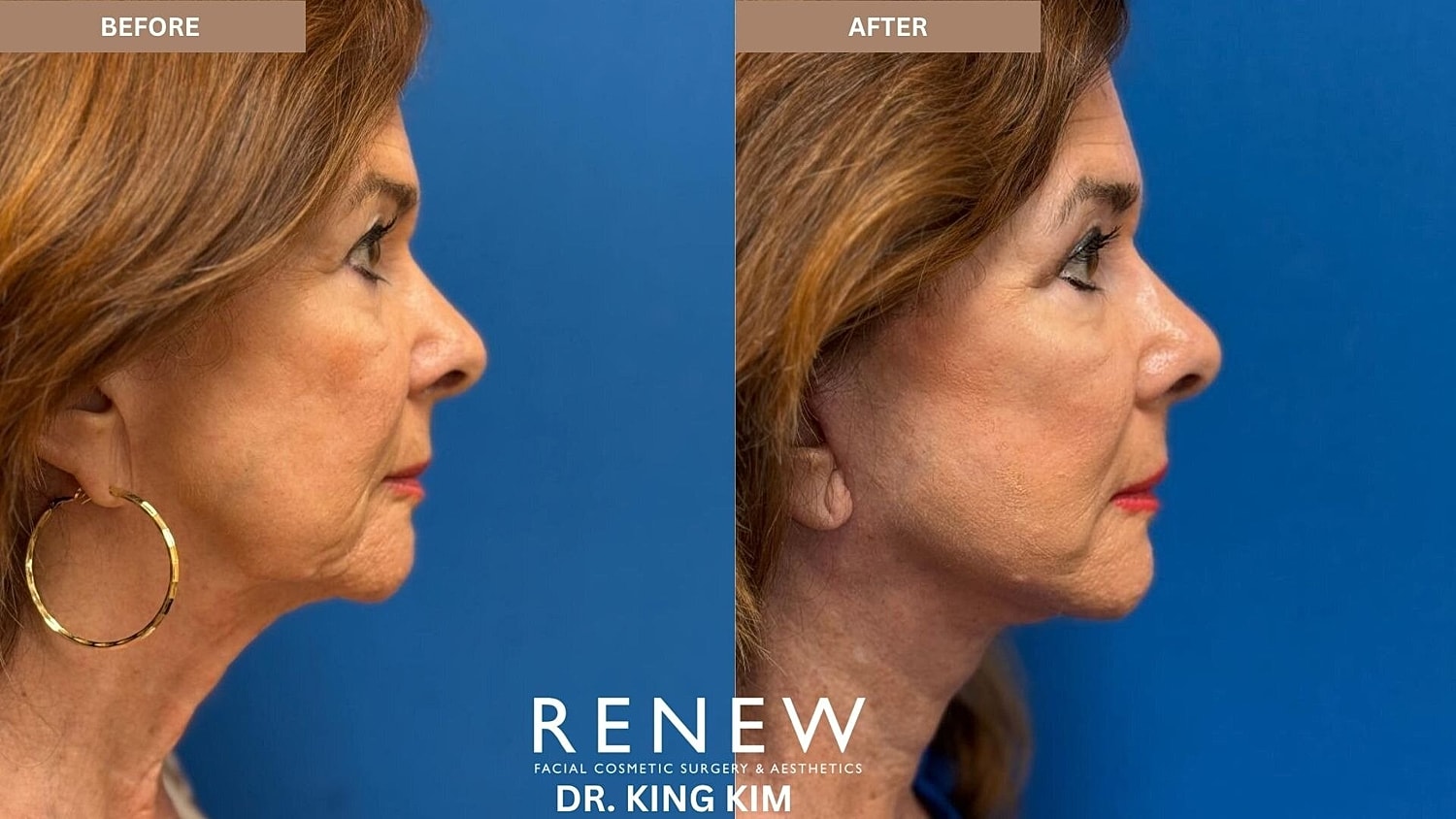 Deep Plane Facelift Before & After