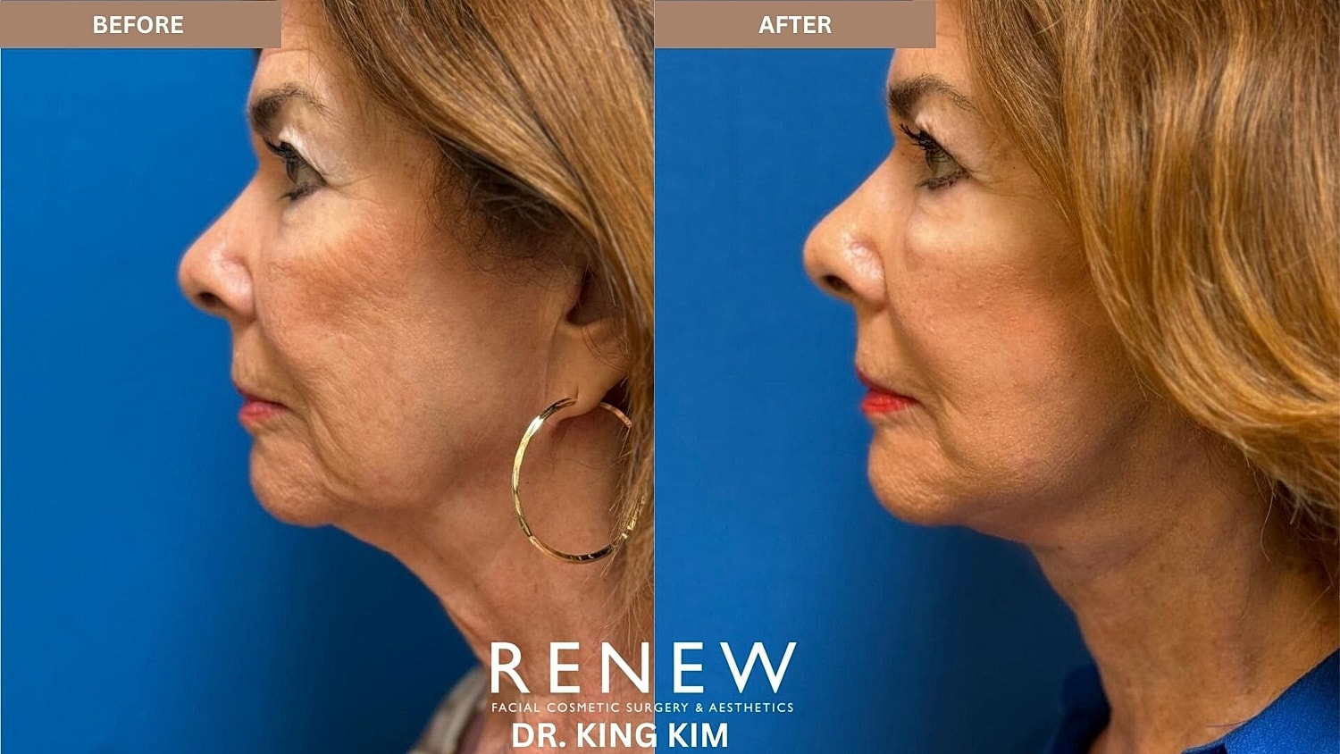 Deep Plane Facelift Before & After