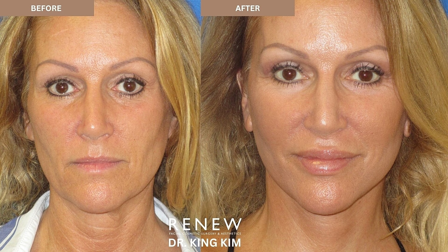 Deep Plane Facelift Before & After