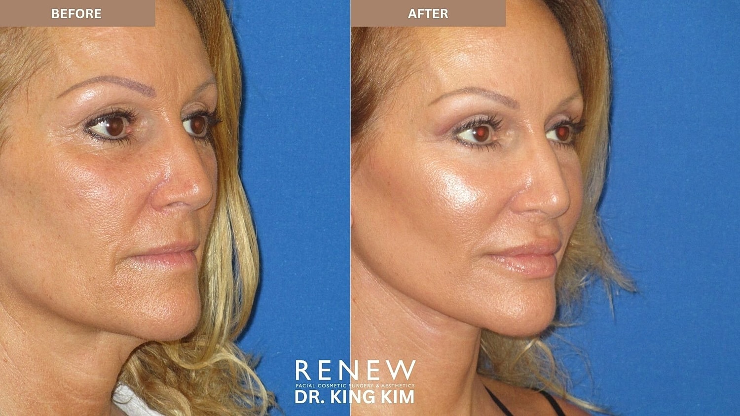 Deep Plane Facelift Before & After