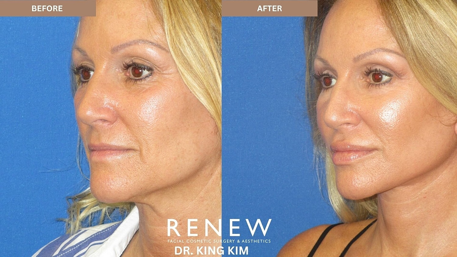 Deep Plane Facelift Before & After