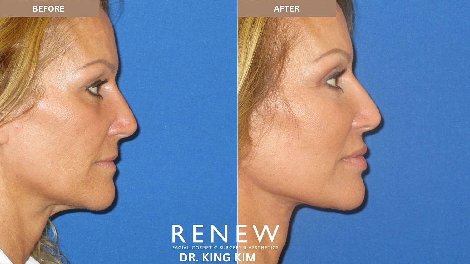 Deep Plane Facelift Before & After