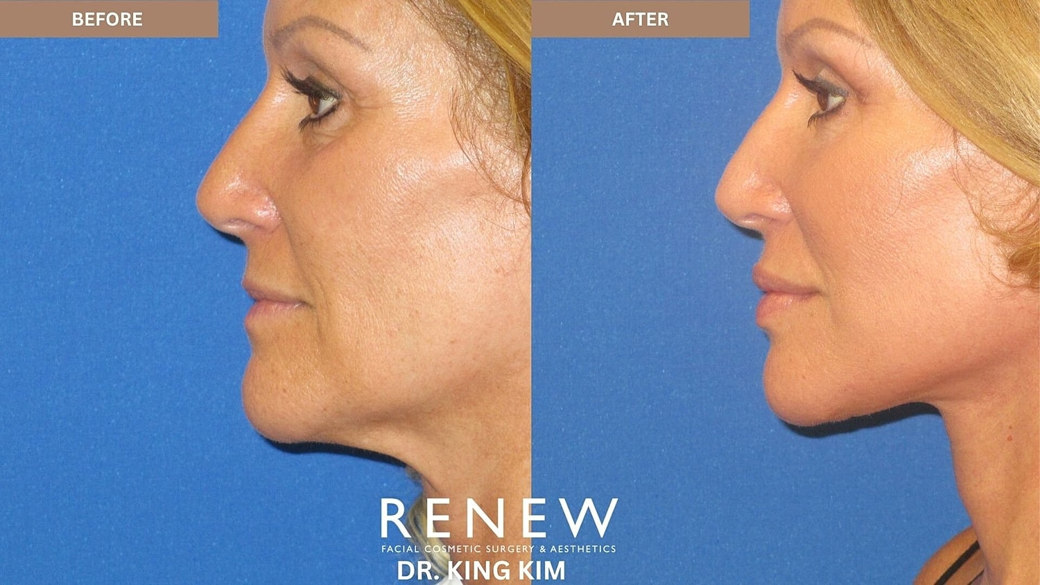 Deep Plane Facelift Before & After