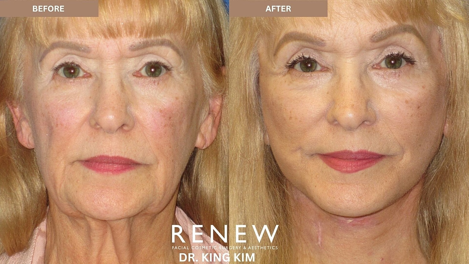 Deep Plane Facelift Before & After