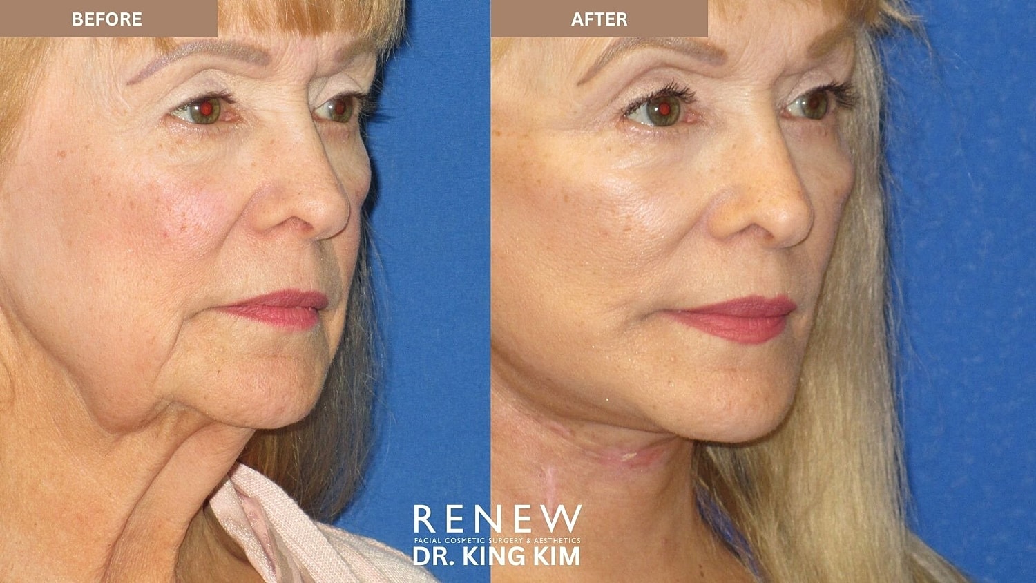 Deep Plane Facelift Before & After