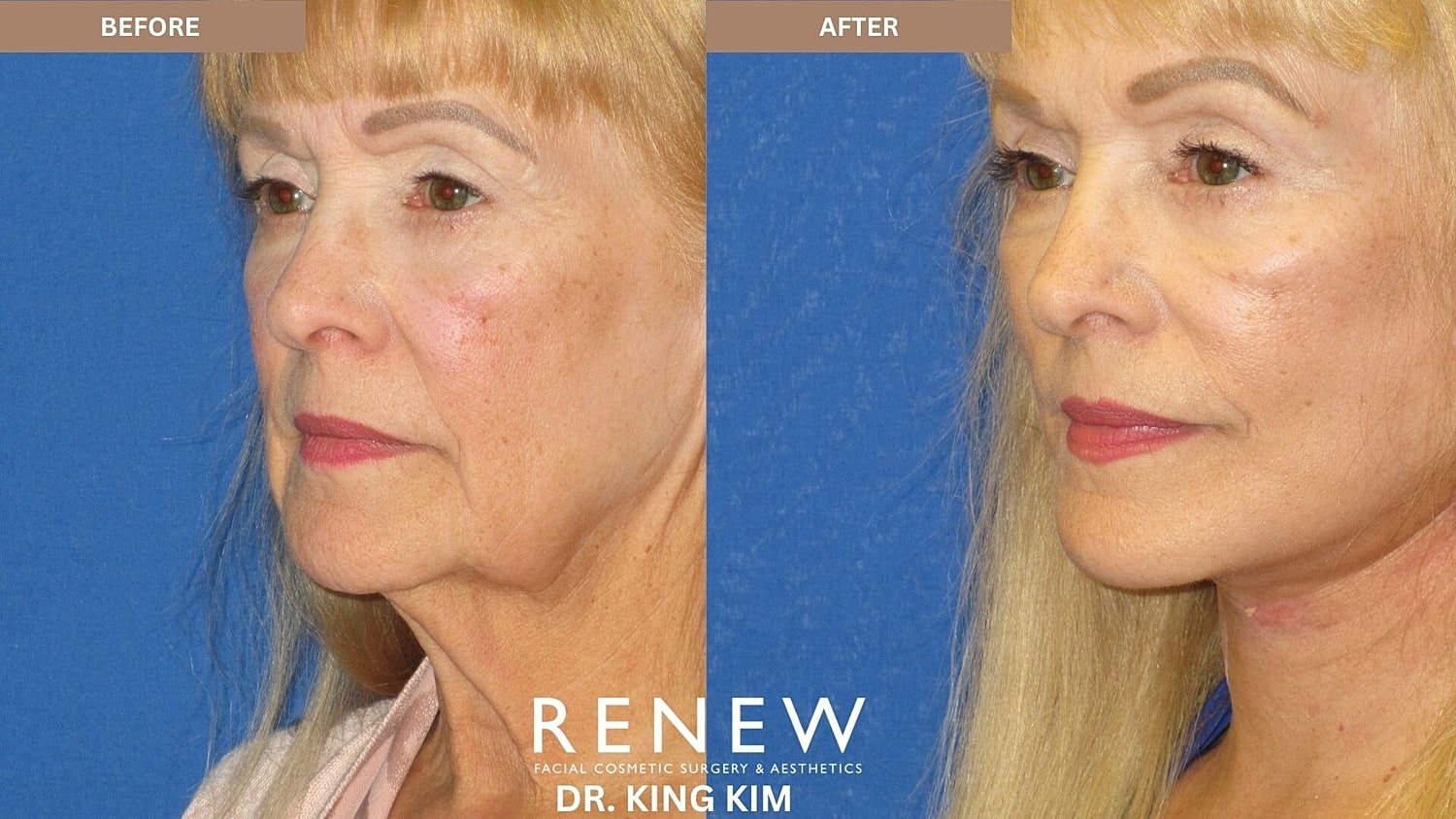 Deep Plane Facelift Before & After