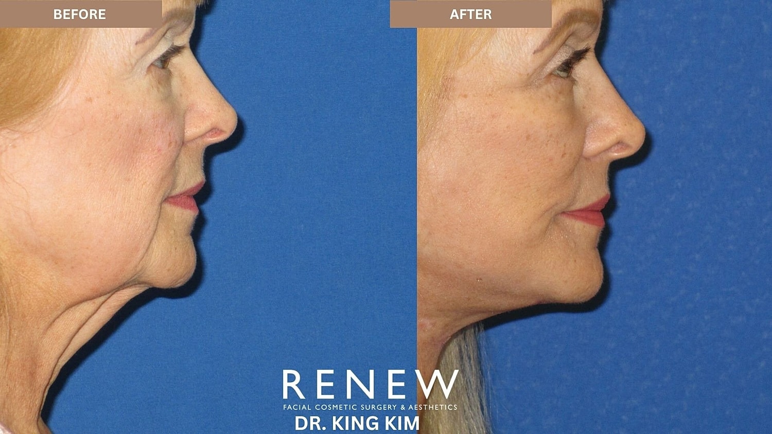 Deep Plane Facelift Before & After