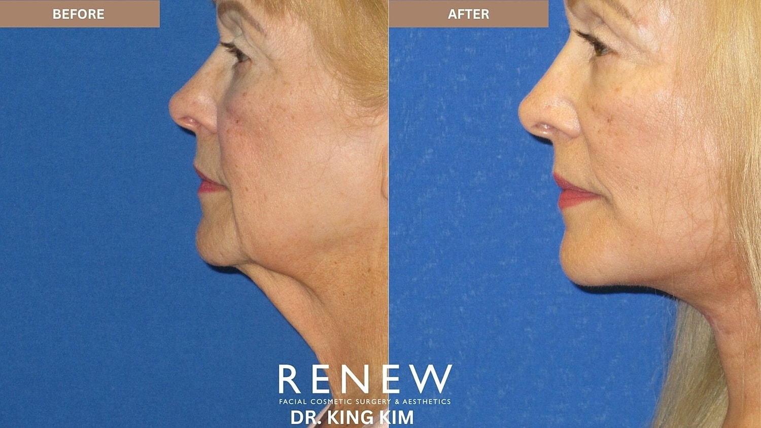 Deep Plane Facelift Before & After