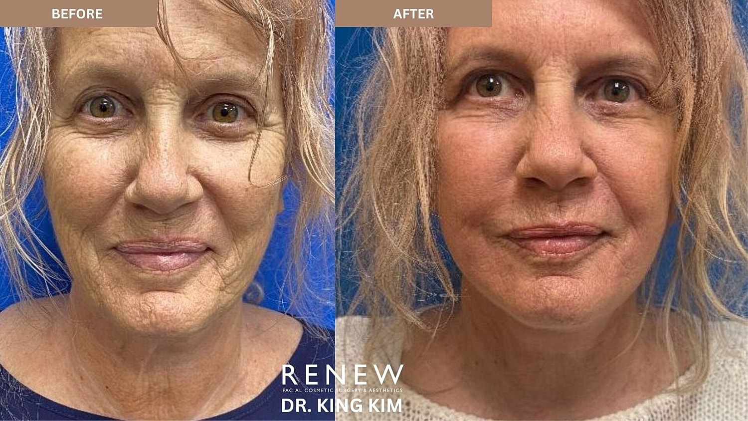 Deep Plane Facelift Before & After