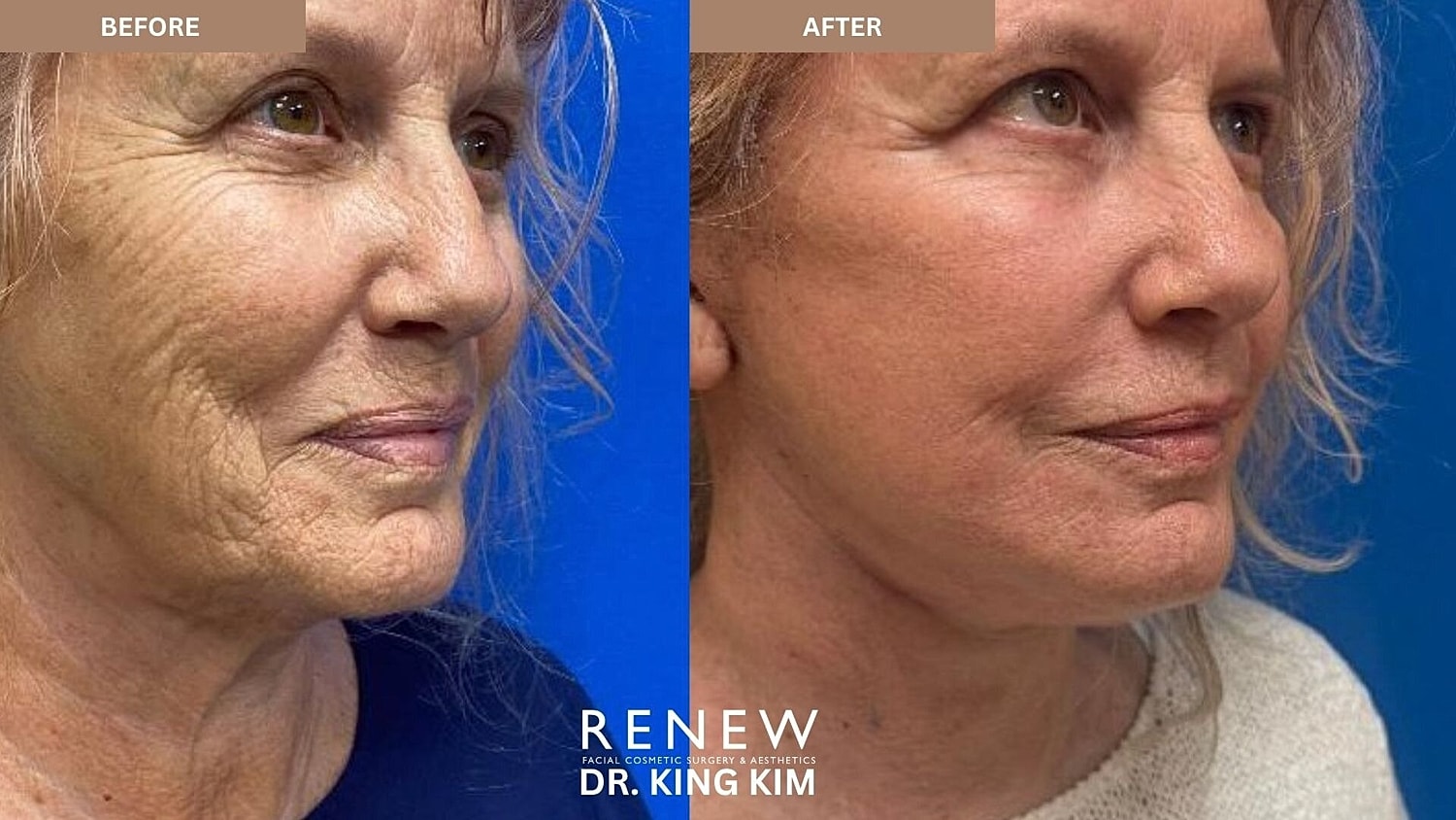 Deep Plane Facelift Before & After