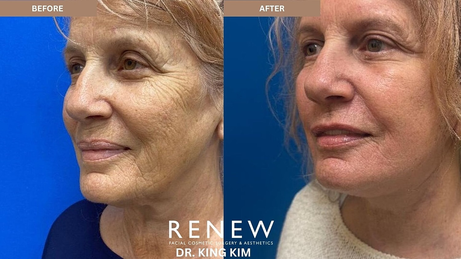 Deep Plane Facelift Before & After